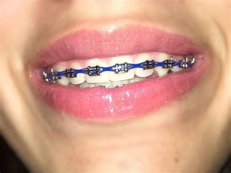 blue braces colors